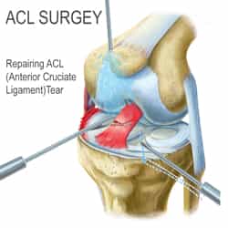 Surgery for a Torn ACL