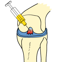 Cortisone in ACL