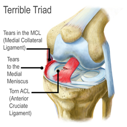 Torn ACL